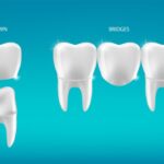 dental crowns vs bridges