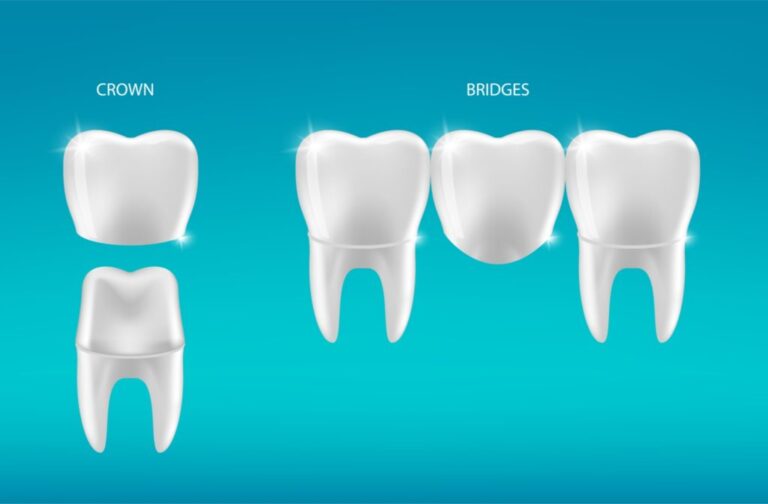 dental crowns vs bridges