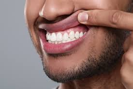 a north legon resident displaying his healed bleeding gum