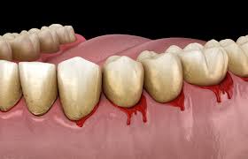 why your gums are bleeding