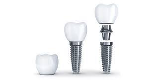 dentures vs implants at akcess dental