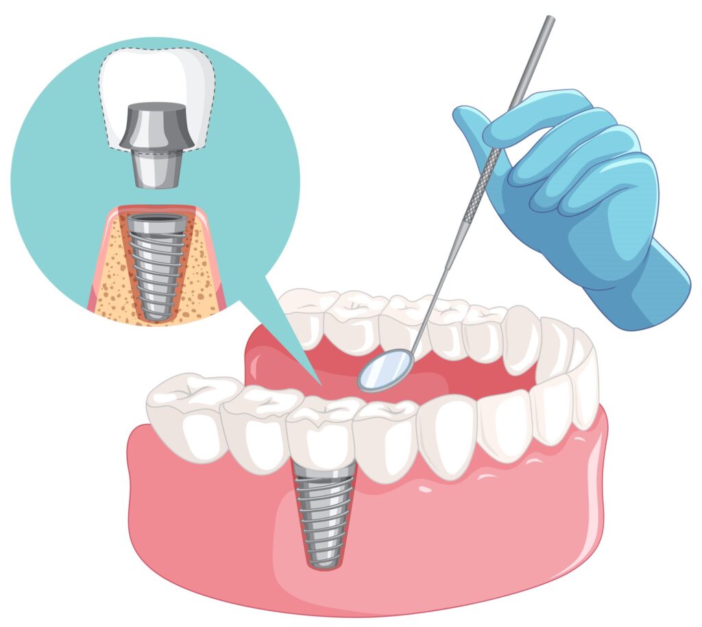 tooth replacement